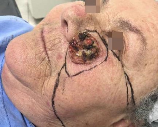 Tumora&ccedil;&atilde;o exof&iacute;tica, com crosta sero-hem&aacute;tica, medindo 3,5cm no seu
                            maior di&acirc;metro, na regi&atilde;o malar esquerda