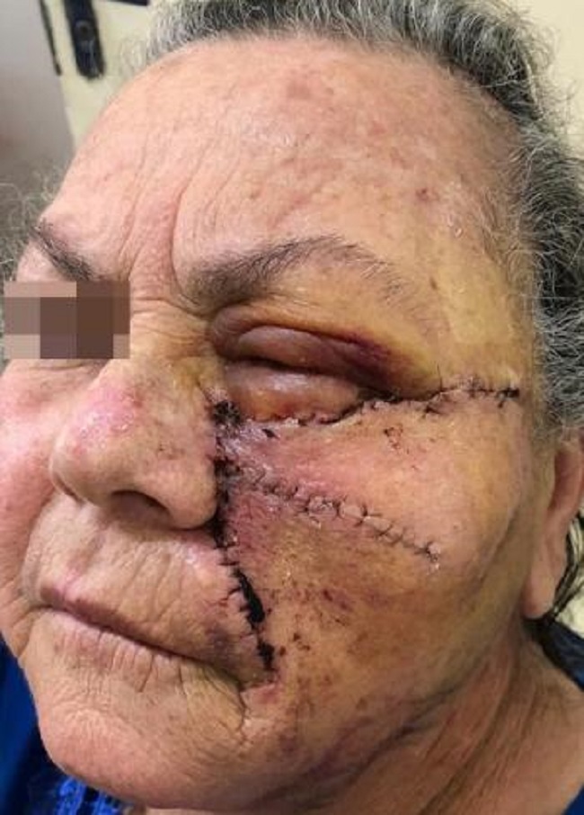 S&eacute;timo dia de p&oacute;s-operat&oacute;rio do retalho A-T. Evidenciam-se edema e
                            discreto hematoma periorbit&aacute;rio esquerdo