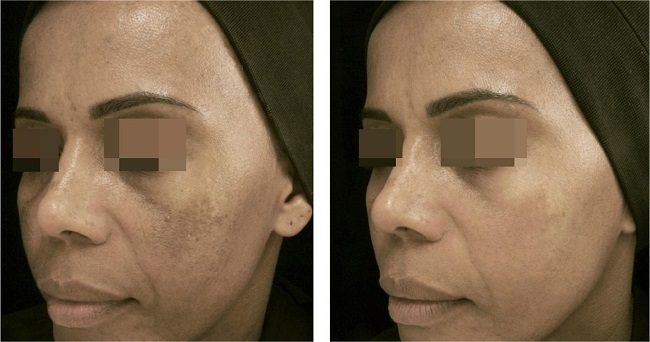 Paciente com melasma facial tratada com cisteamina 5% tópica por toda a noite por 8 semanas