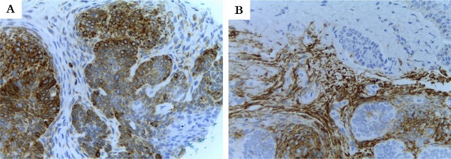 Hamartoma folicular basaloide