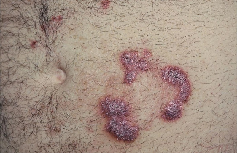 P&aacute;pulas e placas verrucosas na regi&atilde;o periumbilical