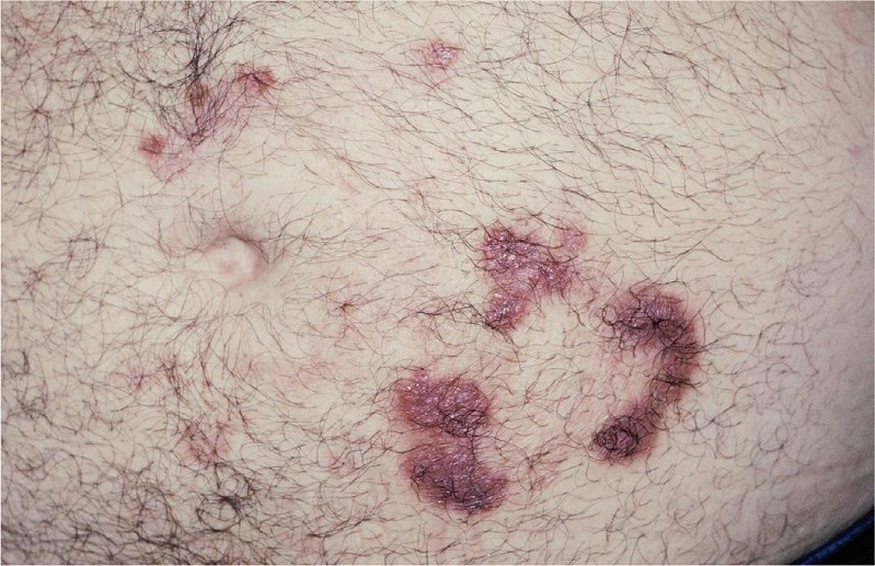 Aspecto das les&otilde;es 45 dias ap&oacute;s primeira sess&atilde;o de crioterapia e uso
							de itraconazol