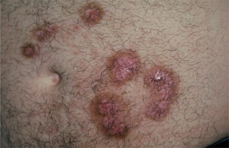 Les&otilde;es maculares residuais ap&oacute;s 90 dias de itraconazol e duas sess&otilde;es
							de crioterapia