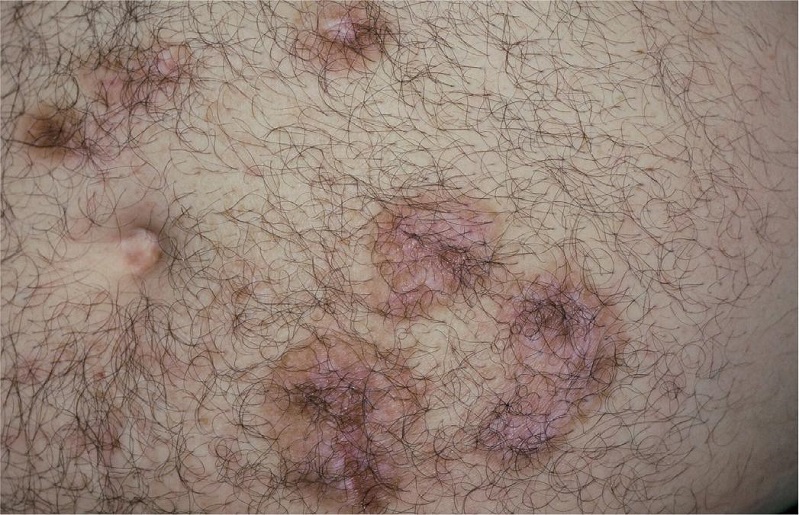 Aspecto final, sem sinais de recidiva