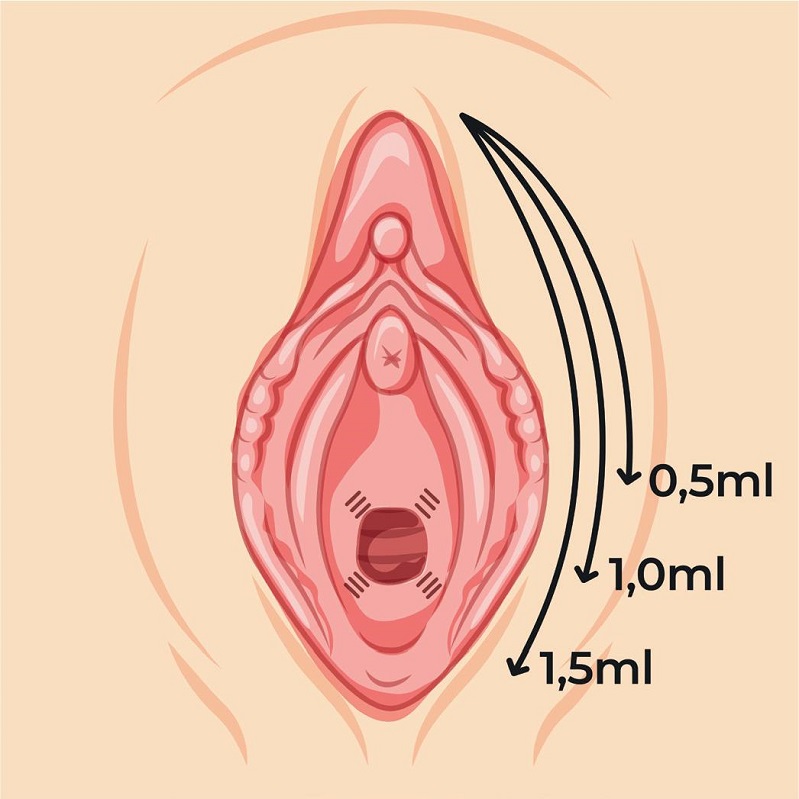 Esquematiza&ccedil;&atilde;o referente &agrave; inje&ccedil;&atilde;o de hidroxiapatita de c&aacute;lcio
							hiperdilu&iacute;da em grandes l&aacute;bios vaginais.