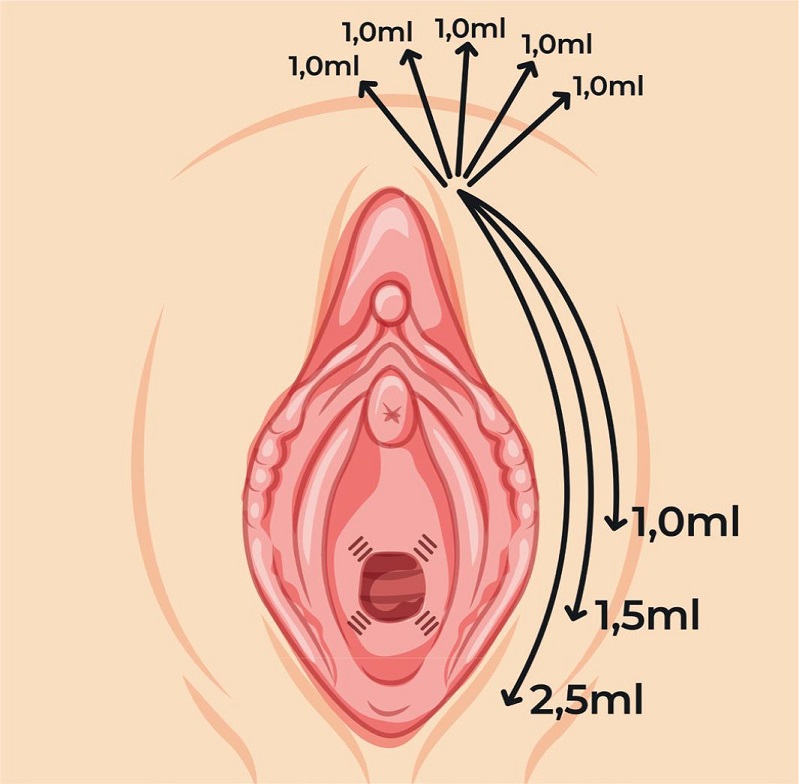 Esquematiza&ccedil;&atilde;o referente &agrave; inje&ccedil;&atilde;o de &aacute;cido l-polil&aacute;tico na
							concentra&ccedil;&atilde;o de 7,5mg/ml em grandes l&aacute;bios vaginais
