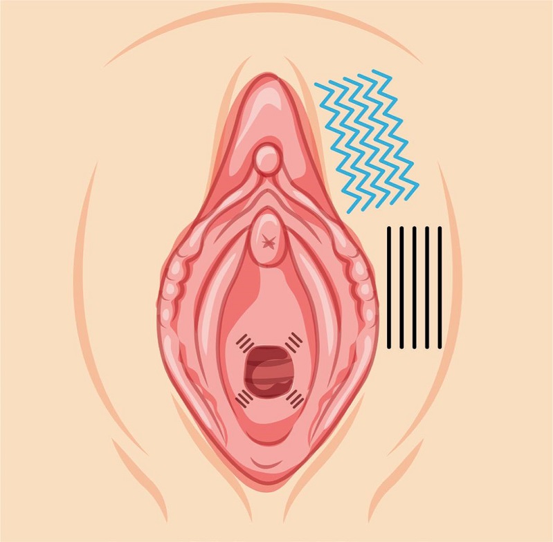 Esquematiza&ccedil;&atilde;o referente &agrave; aplica&ccedil;&atilde;o de fios n&atilde;o espiculados de PDO
							em grandes l&aacute;bios vaginais