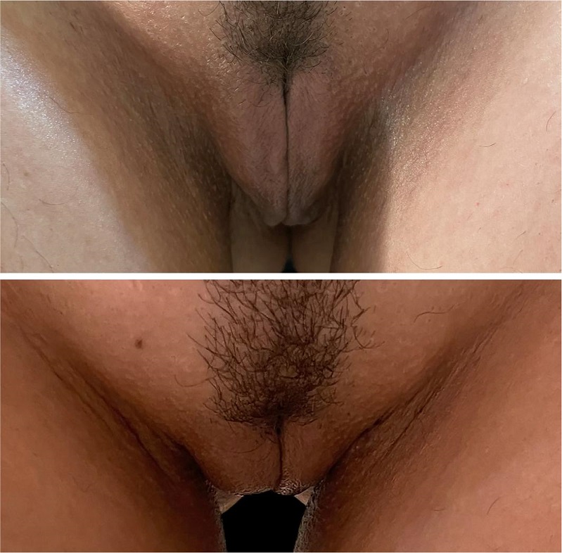 Paciente em posi&ccedil;&atilde;o ortost&aacute;tica - resultado ap&oacute;s duas sess&otilde;es de
							&aacute;cido l-polil&aacute;tico, 30 dias ap&oacute;s a segunda sess&atilde;o. Observar a melhora da
							qualidade da pele e o lifting, com encurtamento da dimens&atilde;o longitudinal
							dos grandes l&aacute;bios. O efeito lifting &eacute; conseguido principalmente pela
							inje&ccedil;&atilde;o do bioestimulador no monte pubiano