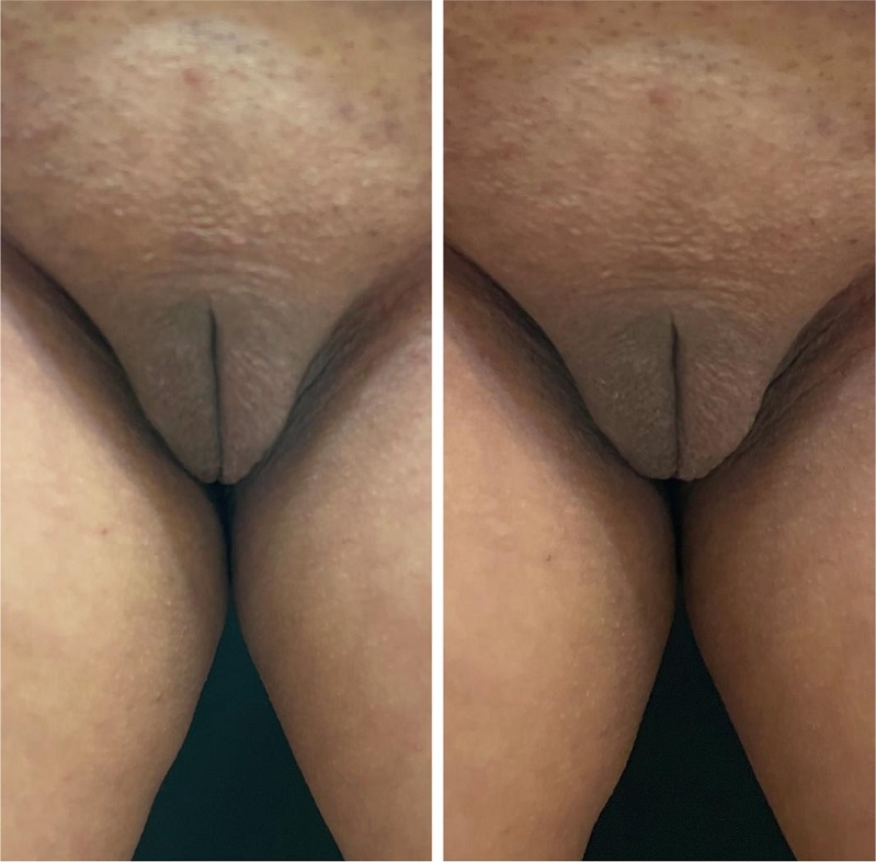 Paciente em posi&ccedil;&atilde;o ortost&aacute;tica - resultado ap&oacute;s sess&atilde;o &uacute;nica da
							aplica&ccedil;&atilde;o de fios de PDO, sendo cinco parafusos no 1/3 superior e cinco
							monofilamentares nos 2/3 inferiores de cada grande l&aacute;bio. Observar o
							lifting, com encurtamento da dimens&atilde;o vertical dos grandes l&aacute;bios. O
							efeito lifting &eacute; conseguido principalmente pela inje&ccedil;&atilde;o dos fios em
							parafuso no 1/3 superior dos grandes l&aacute;bios. Os fios monofilamentares
							melhoram a flacidez local, pouco percept&iacute;vel por documenta&ccedil;&atilde;o
							fotogr&aacute;fica