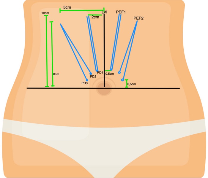 Marca&ccedil;&atilde;o para aplica&ccedil;&atilde;o dos fios no abdome superior. LVI: linha
							vertical imagin&aacute;ria; LHI: linha horizontal imagin&aacute;ria; PEF: ponto de
							entrada do fio; PD: ponto distal do fio