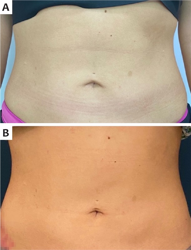 A - abdome, pr&eacute;-tratamento. B - ap&oacute;s 90
							dias do tratamento
