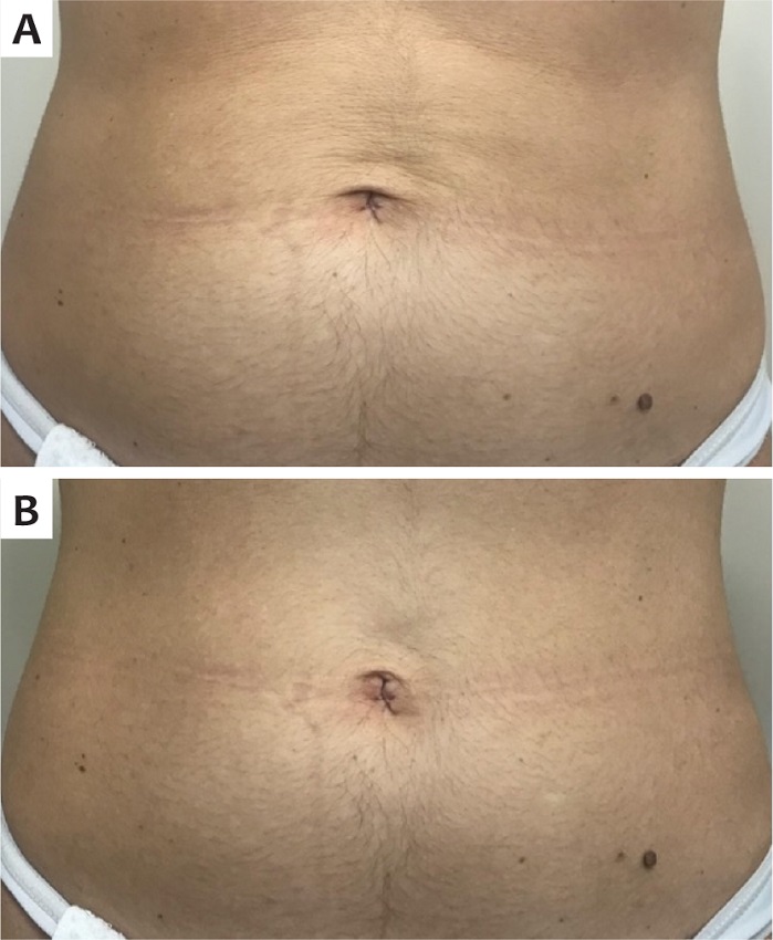 C - abdome pr&eacute;-tratamento. D - ap&oacute;s 90 dias
							do tratamento