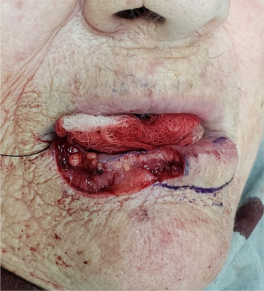 Defeito cir&uacute;rgico de espessura total correspondendo a 45% da extens&atilde;o
							do l&aacute;bio inferior que poupa a rima labial