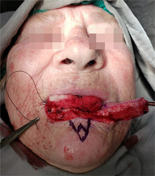 Retalho miomucoso unilateral incisado em espessura total do vermelh&atilde;o
							do l&aacute;bio. M-plastia desenhada para remo&ccedil;&atilde;o subsequente