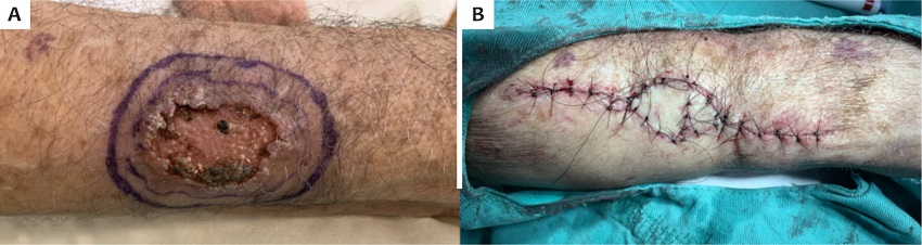 A - Placa eritematosa, com centro ulcerado, bordas bem
							delimitadas e infiltradas, com discreta hiperqueratose. B -
							Fechamento cir&uacute;rgico por enxertia cut&acirc;nea p&oacute;s-ex&eacute;rese da les&atilde;o
