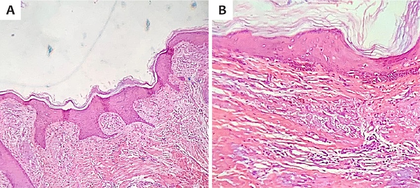 A - Exame histopatol&oacute;gico da borda da les&atilde;o, com
							epiderme apresentando acantose irregular e hiperqueratose, &agrave;s custas de
							orto e paraqueratose (Hematoxilina & eosina, aumento de 40x). B -
							C&eacute;lulas escamosas com intenso grau de perda da polaridade e orienta&ccedil;&atilde;o
							citoarquitetural, intensas atipias citol&oacute;gicas e anaplasia celular, sem
							infiltrar ou ultrapassar a membrana basal. A derme apresentava moderada
							degenera&ccedil;&atilde;o basof&iacute;lica do col&aacute;geno e infiltrado mononuclear difuso
							(Hematoxilina & eosina, aumento de 100x)