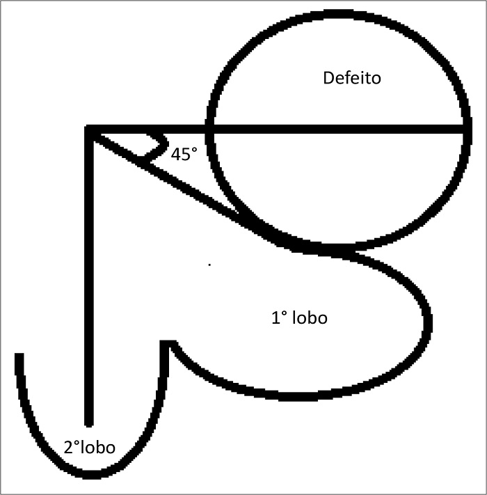 Desenho esquemático do retalho bilobado