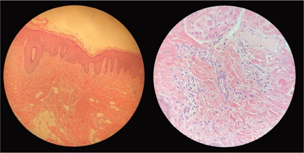 Histopatologia evidenciando epiderme com camada c&oacute;rnea lamelar,
								tamp&otilde;es c&oacute;rneos, acantose irregular moderada, derme com vasos com
								degenera&ccedil;&atilde;o fibrinoide em sua parede, circundada e invadida por
								neutr&oacute;filos, infiltrado moderado e difuso entre as fibras col&aacute;genas
								por linf&oacute;citos, histi&oacute;citos, c&eacute;lulas epitelioides e
								neutr&oacute;filos