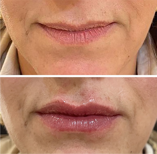 Imagem superior pré e imagem inferior pós-procedimento (imediato).
							Injetadas todas as áreas da sistematização, observando-se volumização do
							tubérculo medial superior pela injeção de K1, volumização e definição do
							arco de cupido por injeção em K2, volumização lateral e melhora do
							contorno do lábio superior por injeção em K3, volumização dos tubérculos
							inferiores por injeção em K4 e melhora do contorno e suspensão dos
							ângulos labiais por injeção de K5. Perceba a ausência de hematomas e o
							edema discreto pós-injeção por cânula