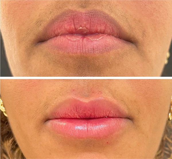 Imagem superior pré e imagem inferior pós-procedimento (imediato).
							Injetadas todas as áreas da sistematização, procurando-se obter,
							principalmente, aumento discreto do lábio inferior e elevação dos
							ângulos labiais