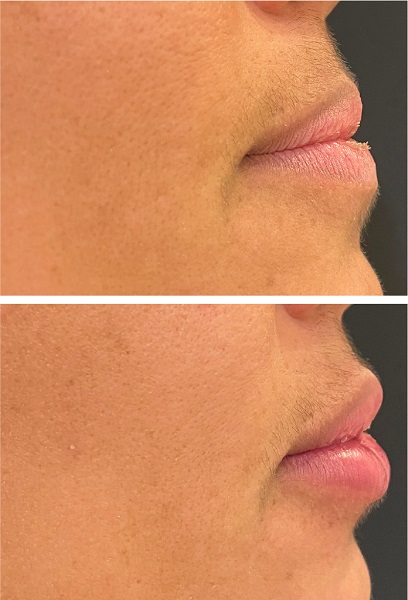 Imagem superior pré e imagem inferior pós-procedimento (imediato).
							Imagem lateral, demonstrando projeção adequada do lábio superior, frente
							ao inferior, de cerca de 2mm, pós-procedimento