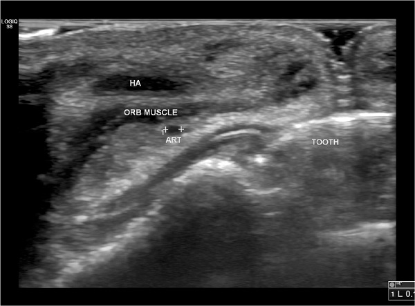 Avaliação ultrassonográfica após preenchimento labial com a técnica
							K.I.S.S. Observe a presença do ácido hialurônico (AH) injetado, em um
							plano seguro, superficial ao músculo orbicular (ORB MUSCLE), distante da
							artéria labial superior (ART)