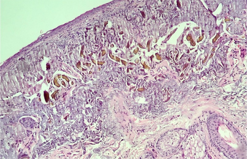 Epiderme retificada; derme com degeneração basofílica do colágeno,
							estruturas alongadas de coloração castanho-amarelada, derrame pigmentar
							e reação de corpo estranho focal. Hematoxilina & eosina, 40x