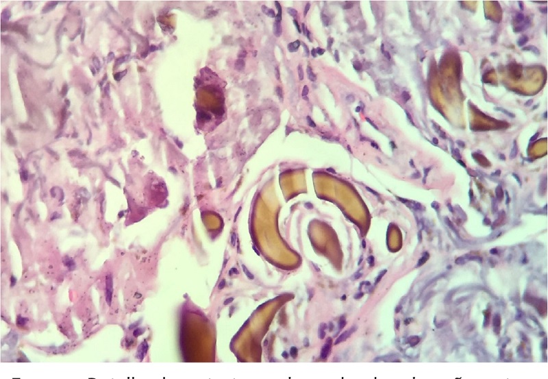 Detalhe das estruturas alongadas de coloração castanho-amarelada.
							Hematoxilina & eosina, 400x