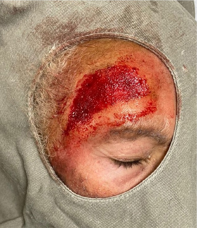 Dermoabrasão com lixa d'água - intraoperatório