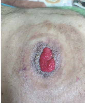 Les&atilde;o periestomal antes da interven&ccedil;&atilde;o terap&ecirc;utica