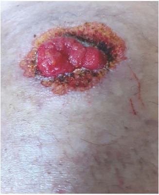 Les&atilde;o periestomal ap&oacute;s quimiocauteriza&ccedil;&atilde;o