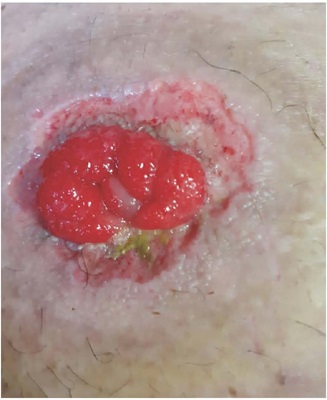 P&oacute;s-interven&ccedil;&atilde;o cir&uacute;rgica