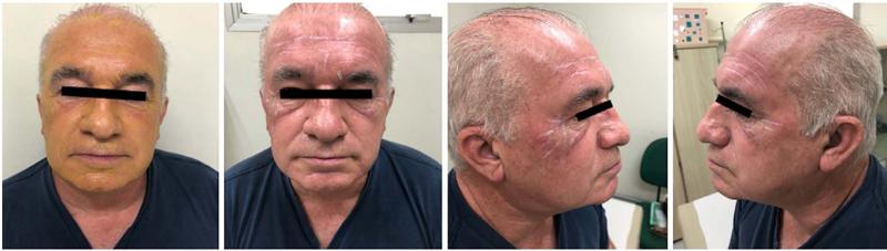 Peeling de &aacute;cido retinoico 5%; forma&ccedil;&atilde;o de
                                frost branco nacarado e leve eritema local com
                            aplica&ccedil;&atilde;o de ATA 30% diretamente nas r&iacute;tides faciais