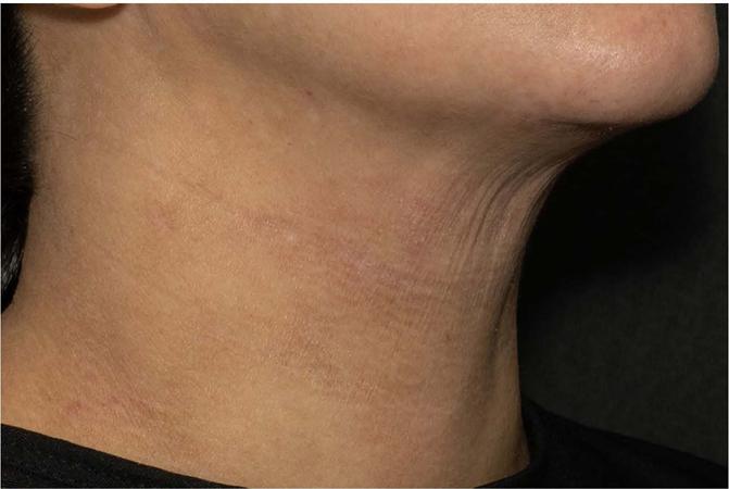 Pescoço antes do tratamento