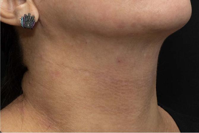 Pescoço após o tratamento