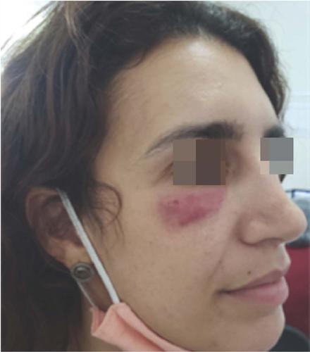 N&oacute;dulo eritematoso na regi&atilde;o infrapalpebral direita