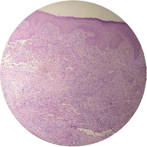 Bi&oacute;psia da les&atilde;o cut&acirc;nea evidenciando um infiltrado inflamat&oacute;rio
                            misto, com ectasia vascular, hemorragia e ac&uacute;mulos de histi&oacute;citos,
                            esbo&ccedil;ando granulomas malformados. Zoom 10x