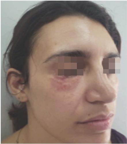 Resultado ap&oacute;s quatro abordagens cir&uacute;rgicas