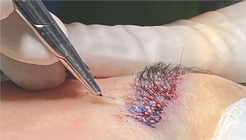 Representa&ccedil;&atilde;o da angula&ccedil;&atilde;o, l&acirc;mina customizada e implanta&ccedil;&atilde;o dos
                            fol&iacute;culos. Autoria pr&oacute;pria