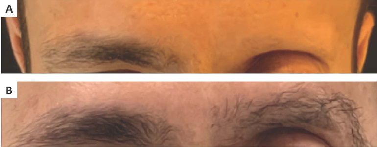 &Aacute;rea de alopecia na regi&atilde;o supraorbital esquerda secund&aacute;ria &agrave;
                            radioterapia pr&eacute;via (A) e seis meses ap&oacute;s TC de sobrancelhas (B).
                            Autoria pr&oacute;pria