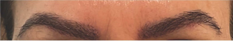 P&oacute;s-operat&oacute;rio de transplante capilar de sobrancelhas ap&oacute;s 10 dias.
                            Autoria pr&oacute;pria