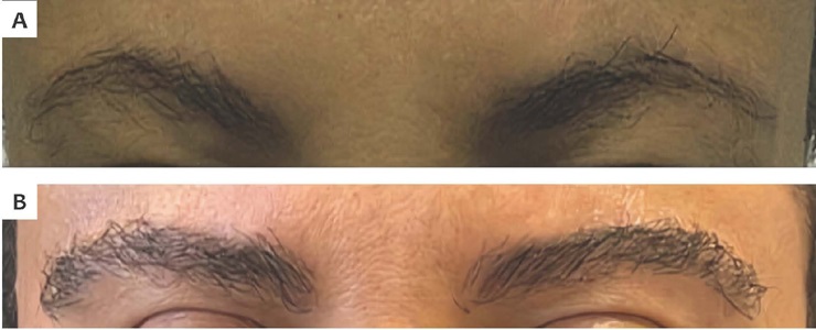 Antes (A) e ap&oacute;s (B) um ano do transplante capilar de sobrancelhas
                            para corre&ccedil;&atilde;o de assimetrias e falhas. Autoria pr&oacute;pria