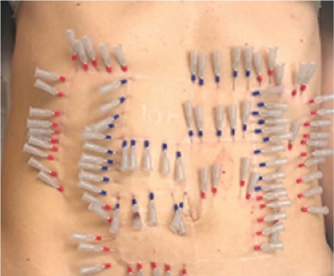 T&eacute;cnica de tratamento da flacidez abdominal utilizando-se 100 fios de
                            PDO: 40 fios em parafuso (canh&atilde;o da agulha azul) e 60 fios twin mono
                            (canh&atilde;o da agulha vermelho). Fios implantados no tecido subcut&acirc;neo
                            superficial