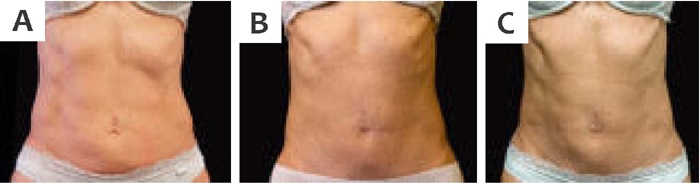 Imagem frontal do abd&ocirc;men em extens&atilde;o. A - Antes do procedimento. B -
                            Um m&ecirc;s ap&oacute;s o procedimento. C - Quatro meses ap&oacute;s o procedimento:
                            melhora da flacidez e contra&ccedil;&atilde;o do tecido, com diminui&ccedil;&atilde;o do
                            pregueamento da pele e reposicionamento da cicatriz umbilical