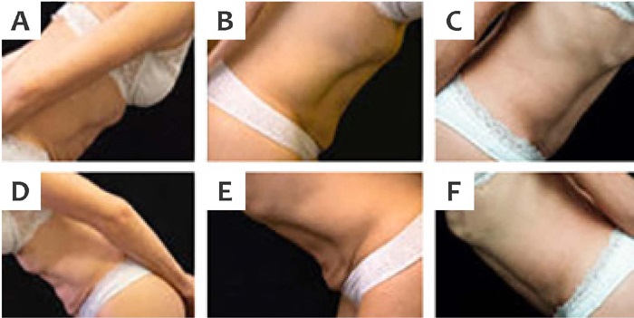 A, B, C, and D - Imagens laterais direita e esquerda do abd&ocirc;men em
                            flex&atilde;o (A, D) antes do procedimento; (B, D) um m&ecirc;s ap&oacute;s o procedimento;
                            e (C, F) quatro meses ap&oacute;s o procedimento: melhora da flacidez e
                            contra&ccedil;&atilde;o do tecido com diminui&ccedil;&atilde;o do pregueamento da pele
