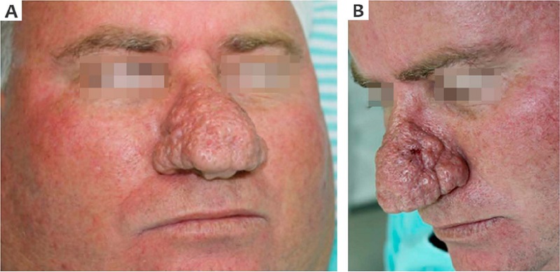 Paciente 1 com placa exof&iacute;tica nasal.