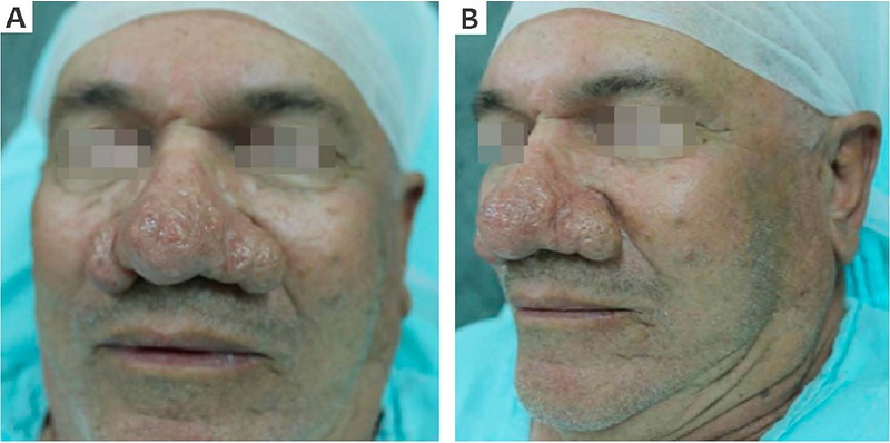 Paciente 2 com placa exof&iacute;tica nasal.