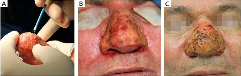 A - Eletrodo em forma de al&ccedil;a para shaving e eletrocoagula&ccedil;&atilde;o. B -
                            Aspecto do p&oacute;s-operat&oacute;rio imediato do paciente 1. C - Aspecto do
                            p&oacute;s-operat&oacute;rio imediato do paciente 2