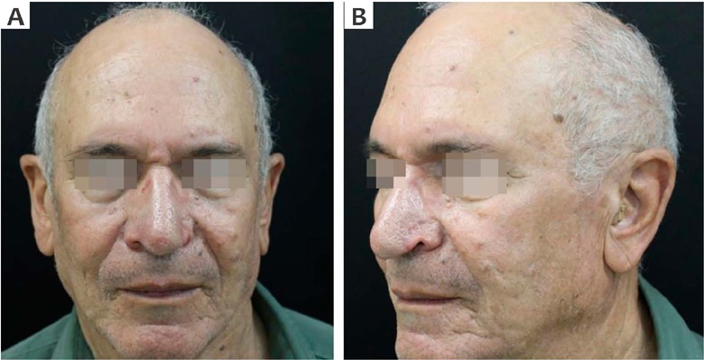 Paciente 2, seis meses ap&oacute;s cirurgia.