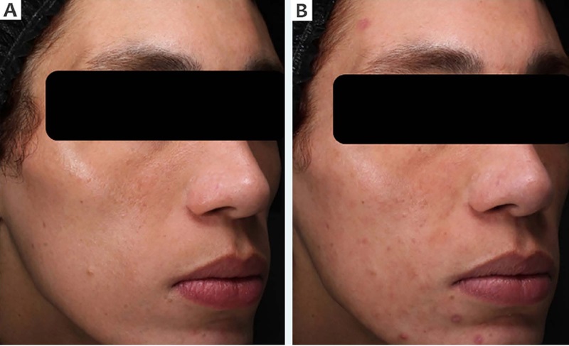 A - Imagens cl&iacute;nicas da lateral direita da face antes do tratamento
                            (D1). B - 40 dias ap&oacute;s o tratamento (D55) - Grupo controle